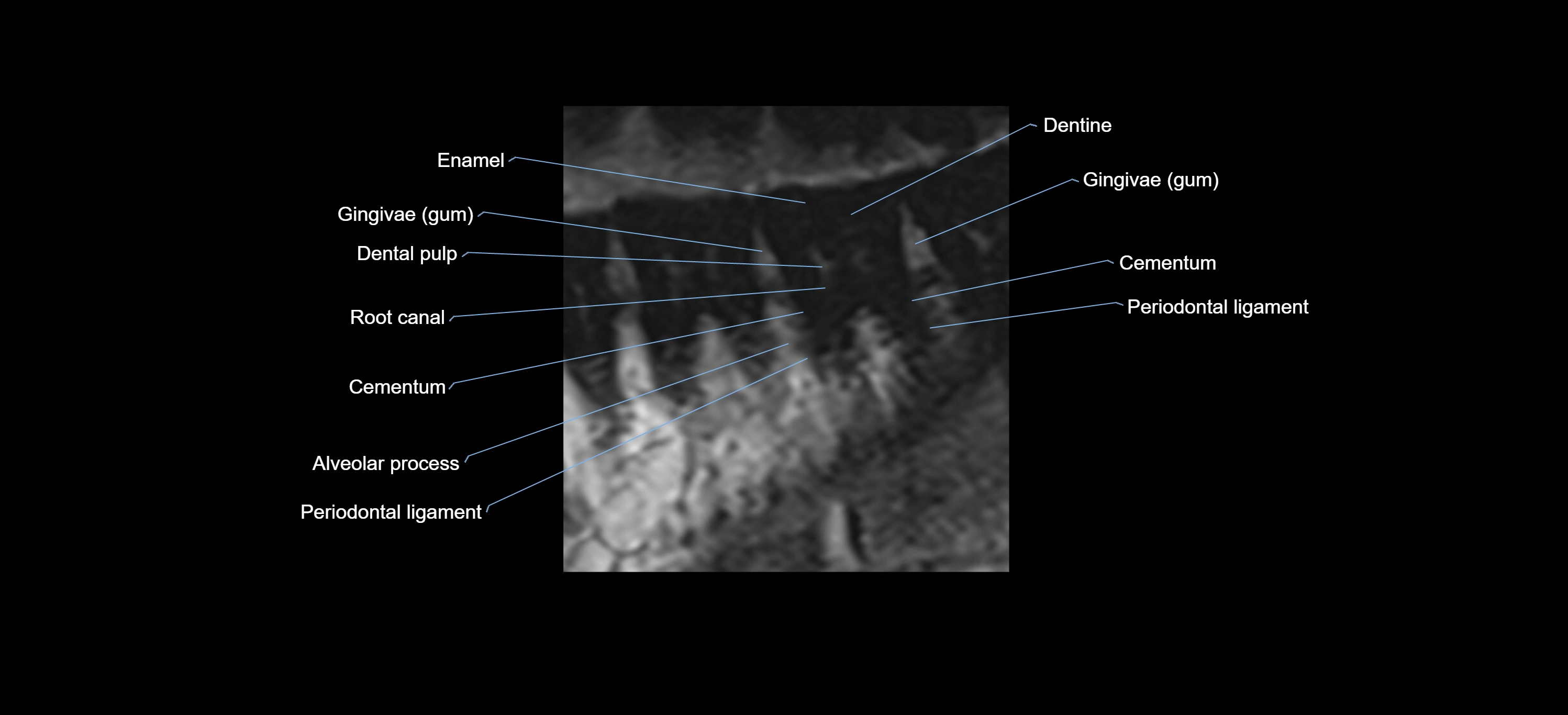 MRI tooth sagittal micro cross sectional 3T labelled anatomy image-00005.webp